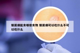 銀屑病能食哪些食物 銀屑病可以吃什么不可以吃什么