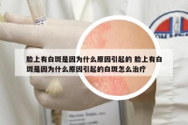 臉上有白斑是因為什么原因引起的 臉上有白斑是因為什么原因引起的白斑怎么治療