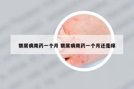 銀屑病用藥一個(gè)月 銀屑病用藥一個(gè)月還是癢