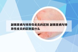 副銀屑病與特異性皮炎的區(qū)別 副銀屑病與特異性皮炎的區(qū)別是什么