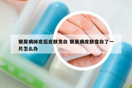 銀屑病掉皮后皮膚發(fā)白 銀屑病皮膚變白了一片怎么辦