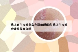 頭上有牛皮癬怎么辦影響睡眠嗎 頭上牛皮癬會(huì)讓頭發(fā)變白嗎