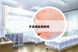 牛皮癬能根除嗎