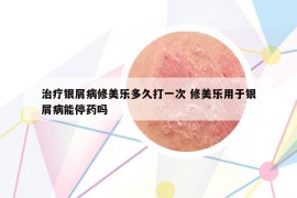 治療銀屑病修美樂多久打一次 修美樂用于銀屑病能停藥嗎