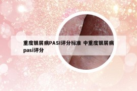 重度銀屑病PASI評分標準 中重度銀屑病pasi評分
