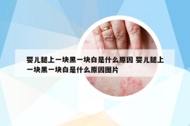 嬰兒腿上一塊黑一塊白是什么原因 嬰兒腿上一塊黑一塊白是什么原因圖片