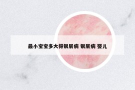 最小寶寶多大得銀屑病 銀屑病 嬰兒