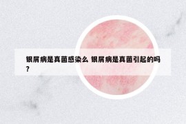 銀屑病是真菌感染么 銀屑病是真菌引起的嗎?