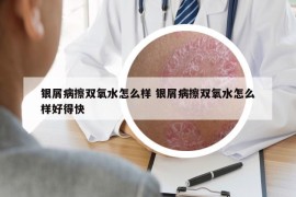 銀屑病擦雙氧水怎么樣 銀屑病擦雙氧水怎么樣好得快