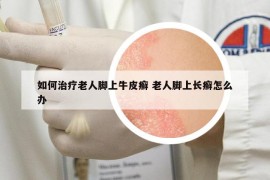 如何治療老人腳上牛皮癬 老人腳上長癬怎么辦