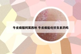 牛皮癬服阿莫西林 牛皮癬能吃抗生素藥嗎