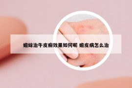 蟾蜍治牛皮癬效果如何呢 蟾皮病怎么治