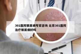 301醫(yī)院銀屑病專家咨詢 北京301醫(yī)院治療銀屑病好嗎