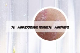 為什么要研究銀屑病 銀屑病為什么要做病理