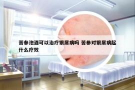 苦參泡酒可以治療銀屑病嗎 苦參對銀屑病起什么療效