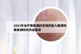 2023年治療銀屑病的生物藥能入醫(yī)保嗎 銀屑病特效藥進醫(yī)保