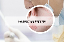 牛皮癬用燈泡考考可不可以