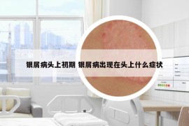 銀屑病頭上初期 銀屑病出現(xiàn)在頭上什么癥狀