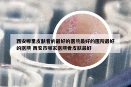 西安哪里皮膚看的最好的醫(yī)院最好的醫(yī)院最好的醫(yī)院 西安市哪家醫(yī)院看皮膚最好