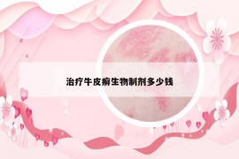 治療牛皮癬生物制劑多少錢