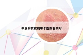 牛皮癬皮膚病哪個醫(yī)院看的好