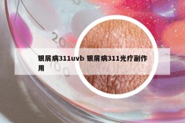 銀屑病311uvb 銀屑病311光療副作用