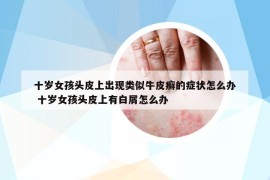 十歲女孩頭皮上出現(xiàn)類似牛皮癬的癥狀怎么辦 十歲女孩頭皮上有白屑怎么辦