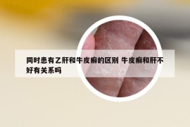 同時患有乙肝和牛皮癬的區(qū)別 牛皮癬和肝不好有關(guān)系嗎