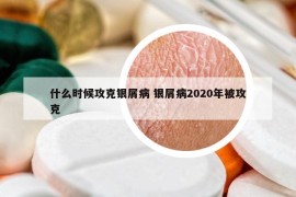 什么時候攻克銀屑病 銀屑病2020年被攻克