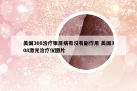 美國308治療銀屑病有沒有副作用 美國308激光治療儀圖片