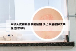 大塊頭皮和銀屑病的區(qū)別 頭上銀屑病掉大塊皮是好轉嗎