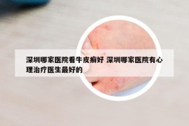 深圳哪家醫(yī)院看牛皮癬好 深圳哪家醫(yī)院有心理治療醫(yī)生最好的