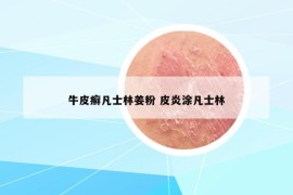 牛皮癬凡士林姜粉 皮炎涂凡士林