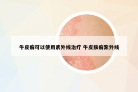 牛皮癬可以使用紫外線治療 牛皮膚癬紫外線