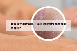兒童得了牛皮癬能上課嗎 孩子得了牛皮皮癬忌口嗎?