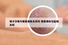 嗓子沙啞與銀屑病有關(guān)系嗎 銀屑病會引起咽炎嗎