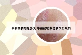 牛癬的初期是多久 牛癬的初期是多久出現(xiàn)的