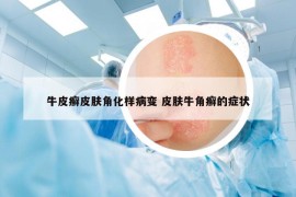 牛皮癬皮膚角化樣病變 皮膚牛角癬的癥狀