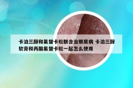 卡泊三醇和氟替卡松聯(lián)合治銀屑病 卡泊三醇軟膏和丙酸氟替卡松一起怎么使用