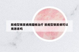 膿皰型銀屑病用醋精治療 膿皰型銀屑病可以用激素嗎