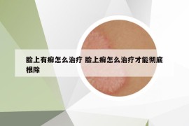 臉上有癬怎么治療 臉上癬怎么治療才能徹底根除