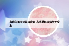 點滴型銀屑病能否痊愈 點滴型銀屑病能否痊愈