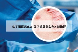 生了銀屑怎么辦 生了銀屑怎么辦才能治好