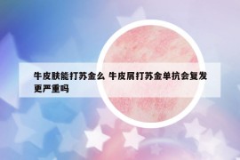 牛皮膚能打蘇金么 牛皮屑打蘇金單抗會(huì)復(fù)發(fā)更嚴(yán)重嗎