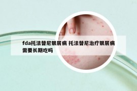 fda托法替尼銀屑病 托法替尼治療銀屑病需要長(zhǎng)期吃嗎
