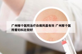 廣州哪個醫(yī)院治療白癜風最有效 廣州那個醫(yī)院看婦科比較好