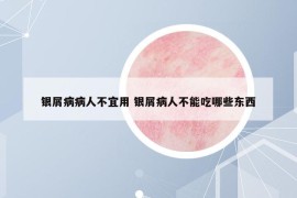 銀屑病病人不宜用 銀屑病人不能吃哪些東西