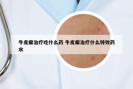 牛皮廨治療吃什么藥 牛皮廨治療什么特效藥水