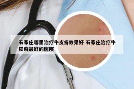 石家莊哪里治療牛皮癬效果好 石家莊治療牛皮癬最好的醫(yī)院