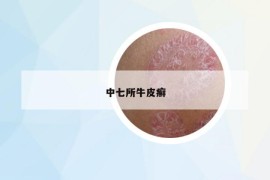 中七所牛皮癬